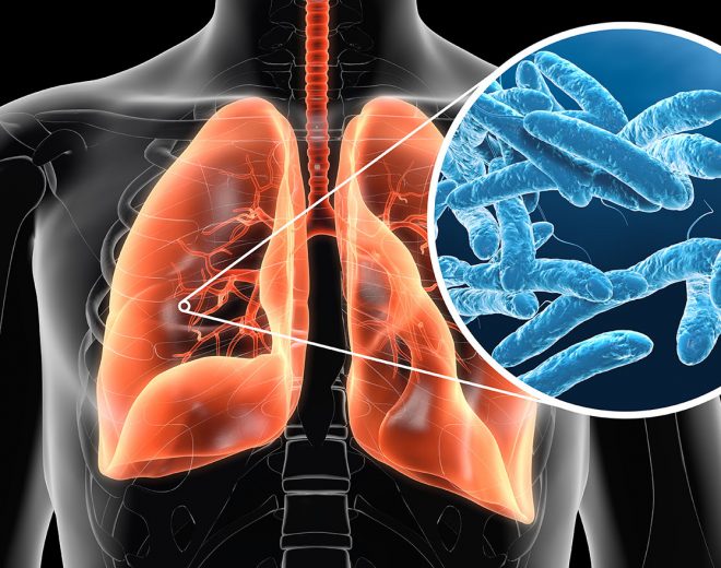 The Long Term Dangers Of Legionella